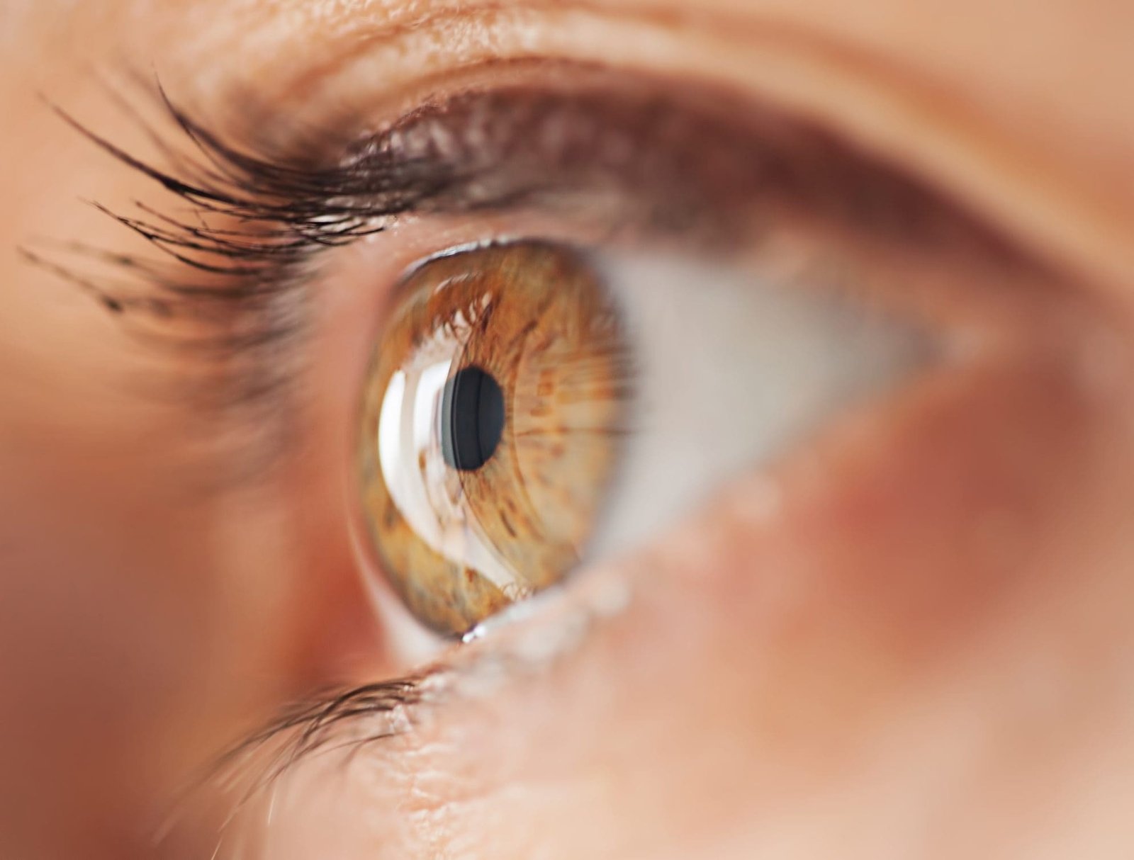 Can cataracts happen in young adults?