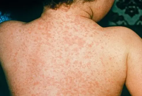 What to Do if You or Your Child Has Measles
