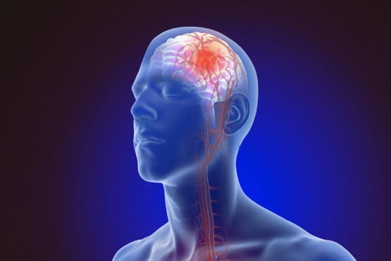 How to spot stroke symptoms early: Act FAST to save a life