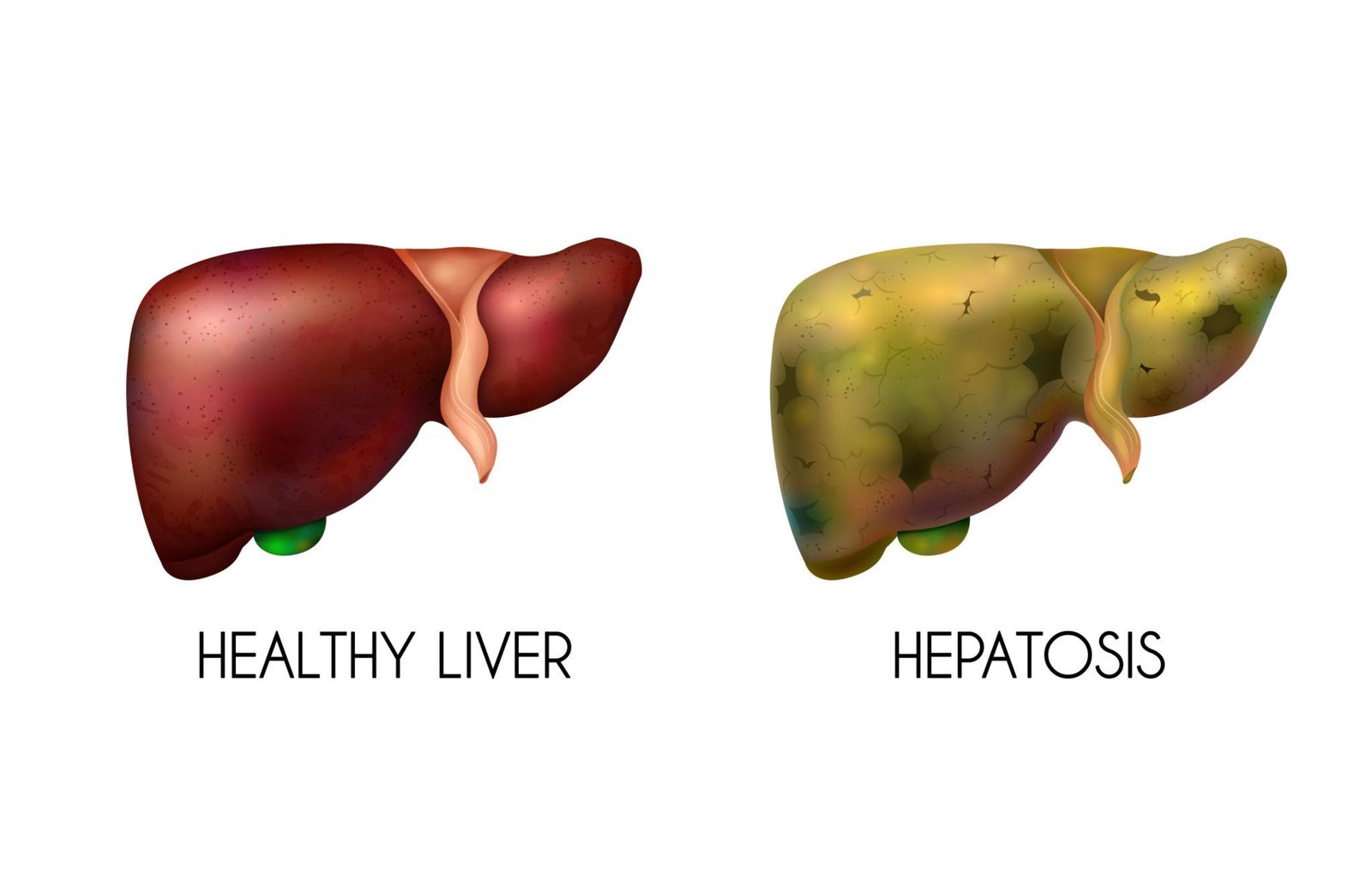 Fatty Liver Disease Is Rising Among Young Adults: What You Need to Know